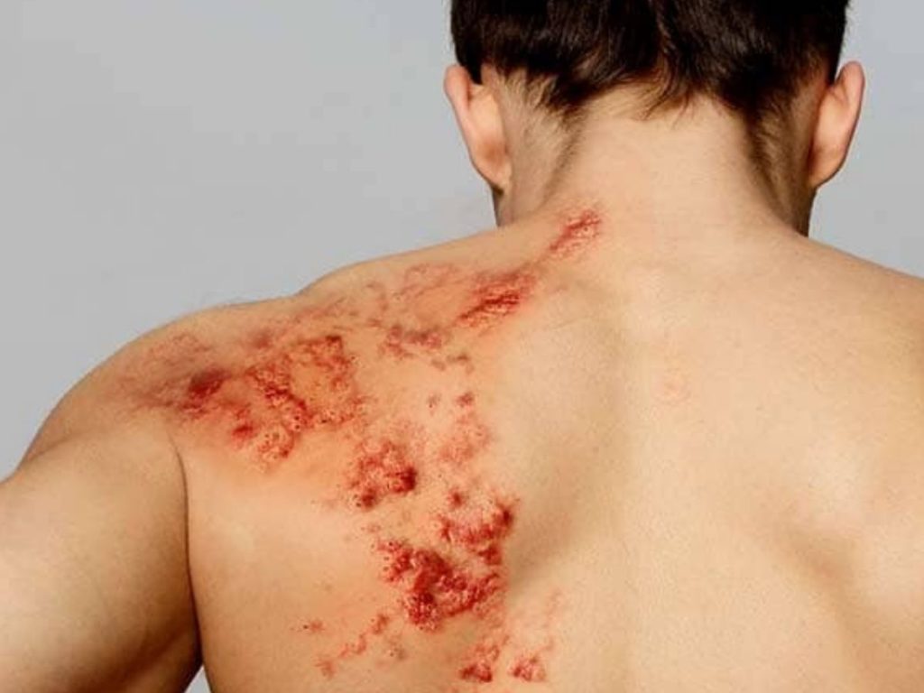 man with severe shingles at the back