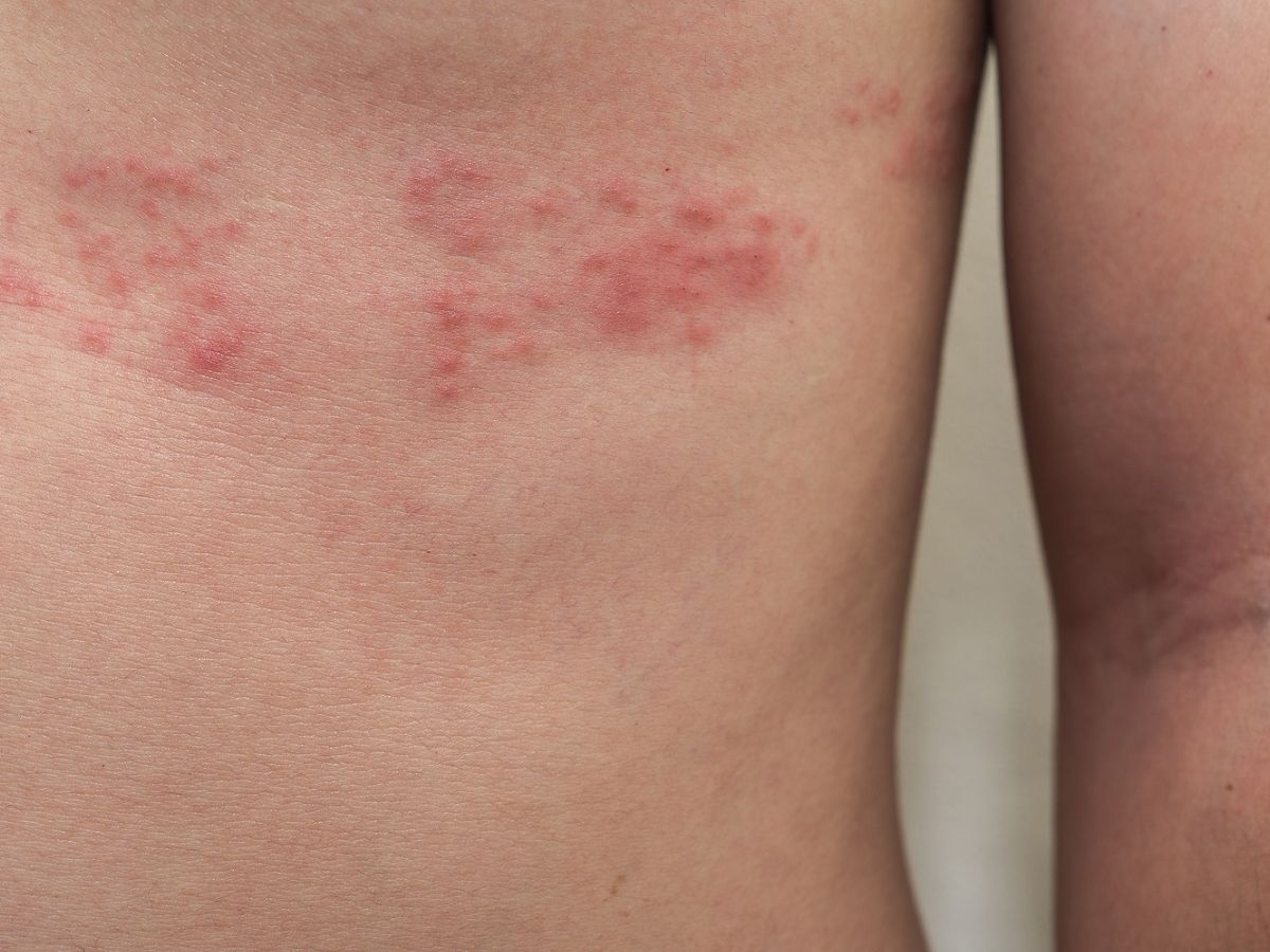 shingles on torso